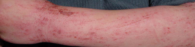 Atopic dermatitis child